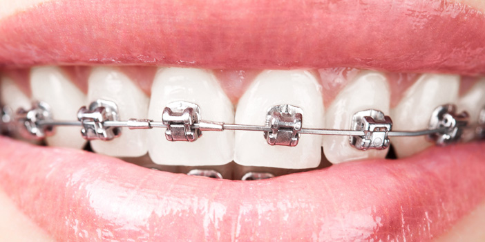 What are the types of braces?