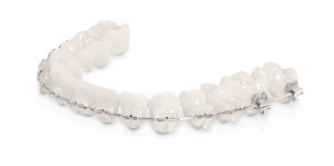 Prevent Ceramic Braces from Staining - Biermann Orthodontics