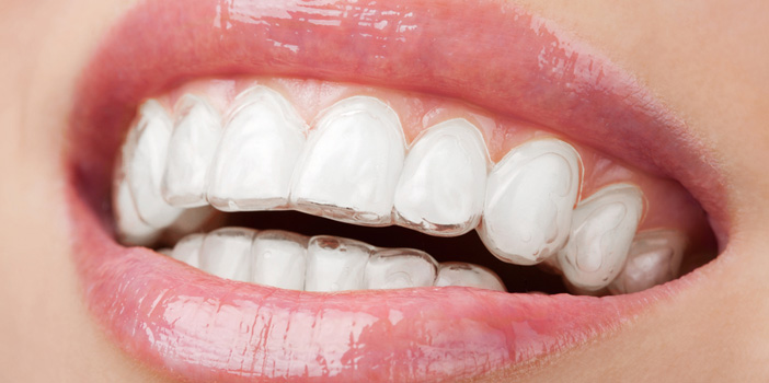 invisalign-braces