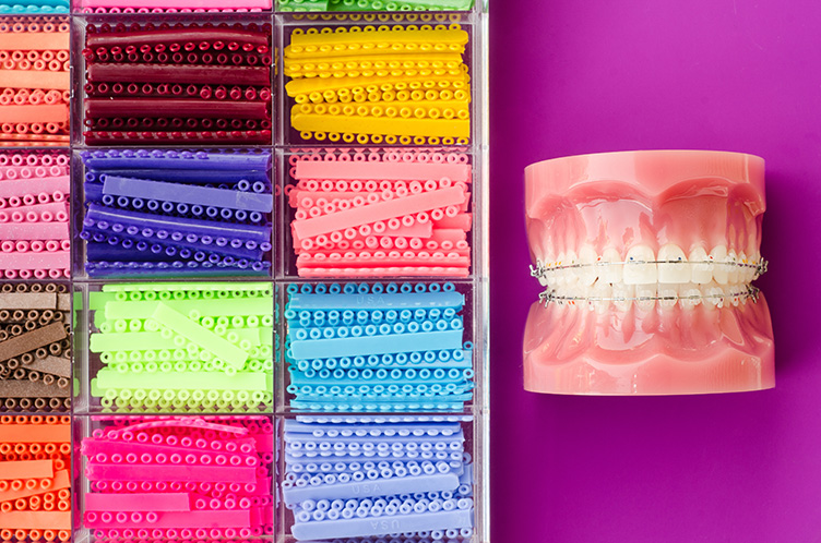 Rubber Bands in Your Mouth: Why You Need to Wear Elastics for Braces