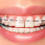 7 Tips to Prevent Ceramic Braces From Staining