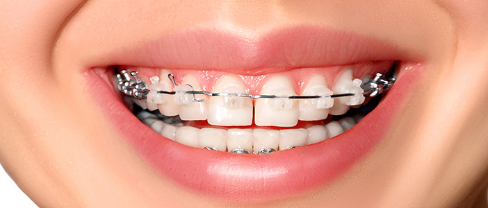 7 Tips to Prevent Ceramic Braces From Staining