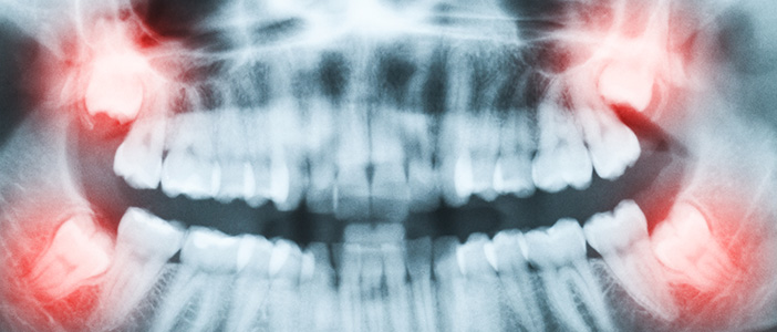 Types of Teeth