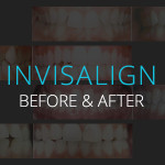 Invisalign Before & After - Biermann Orthodontics