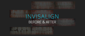 Invisalign Before & After - Biermann Orthodontics