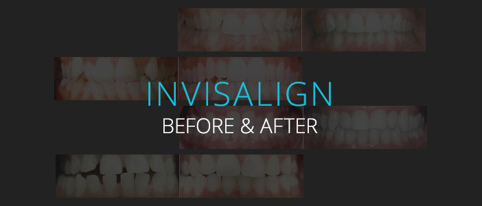 Invisalign Before & After - Biermann Orthodontics