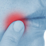 Mouth Sores - Stomatitis