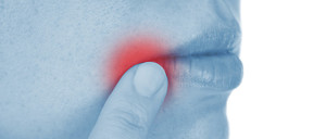 Mouth Sores - Stomatitis