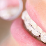 Tips for Keeping Braces Clean