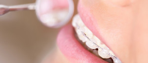 Tips for Keeping Braces Clean