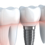 About Dental Implants