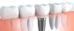 About Dental Implants