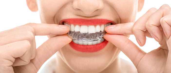 Invisible Aligners for Teeth - Biermann Orthodontics