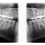 Temporary Anchorage Device (TAD) use in the treatment of anterior open bite