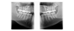 Temporary Anchorage Device (TAD) use in the treatment of anterior open bite