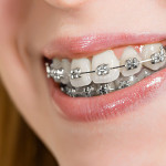 When Should I Get Braces?