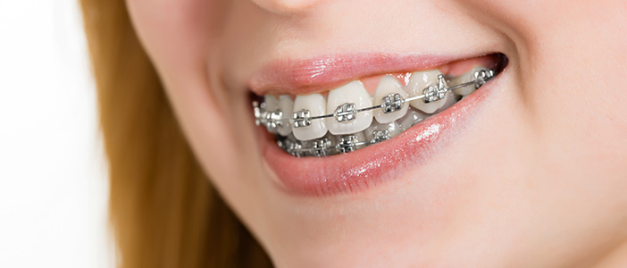 When Should I Get Braces?