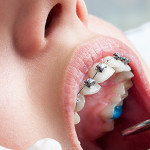 White Spots on Teeth During Orthodontic Treatment