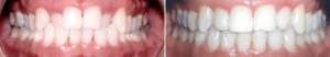 Crossbite Fixed with Invisalign