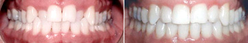 Crossbite Fixed with Invisalign