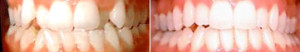 Overcrowded teeth fixed with Invisalign
