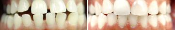 Gapped Teeth Fixed with Invisalign