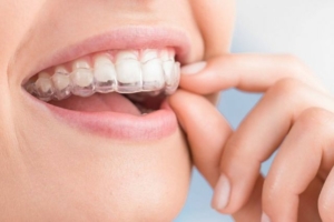 invisalign