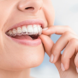 invisalign