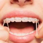 Elastic Timing: When Do Rubber Bands Join the Braces Party?
