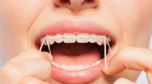Elastic Timing: When Do Rubber Bands Join the Braces Party?