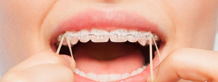Elastic Timing: When Do Rubber Bands Join the Braces Party?
