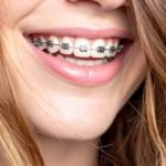 what age can kids get braces