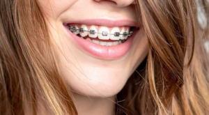 what age can kids get braces