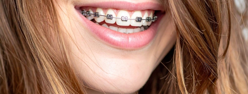 what age can kids get braces