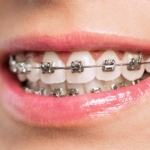 how to know if you need braces