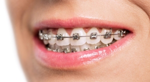 how to know if you need braces