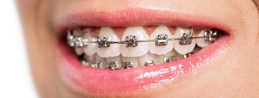 how to know if you need braces